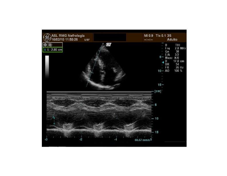 La disfunzione ventricolare destra e l'ipertensione arteriosa polmonare